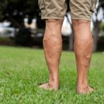 vein conditions in men