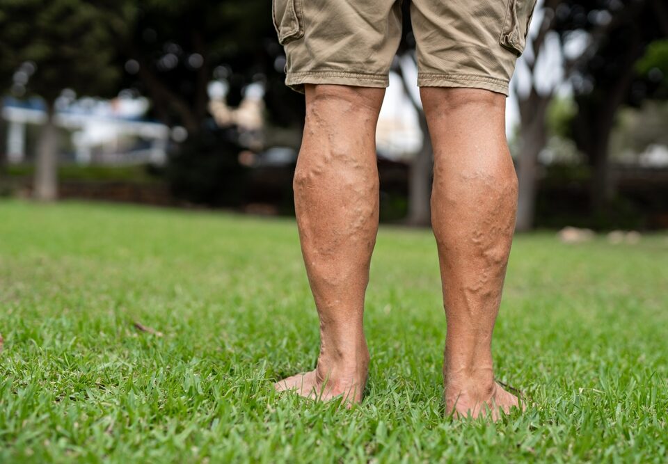 vein conditions in men