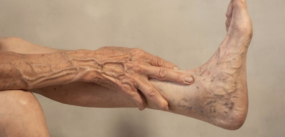 woman with venous disease near Columbia Maryland