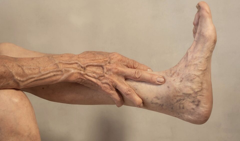 woman with venous disease near Columbia Maryland