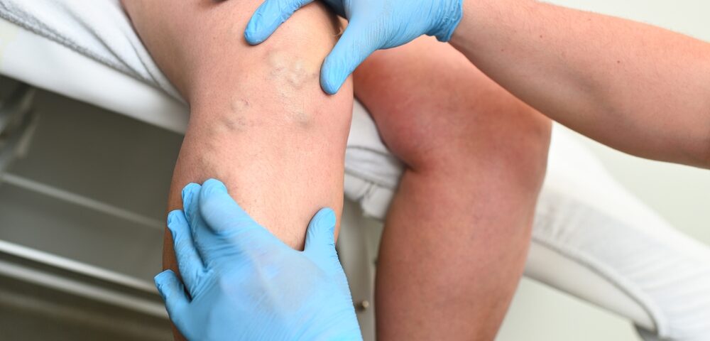 vein issues Bel Air Maryland