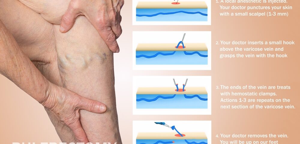 Ambulatory Phlebectomy Baltimore