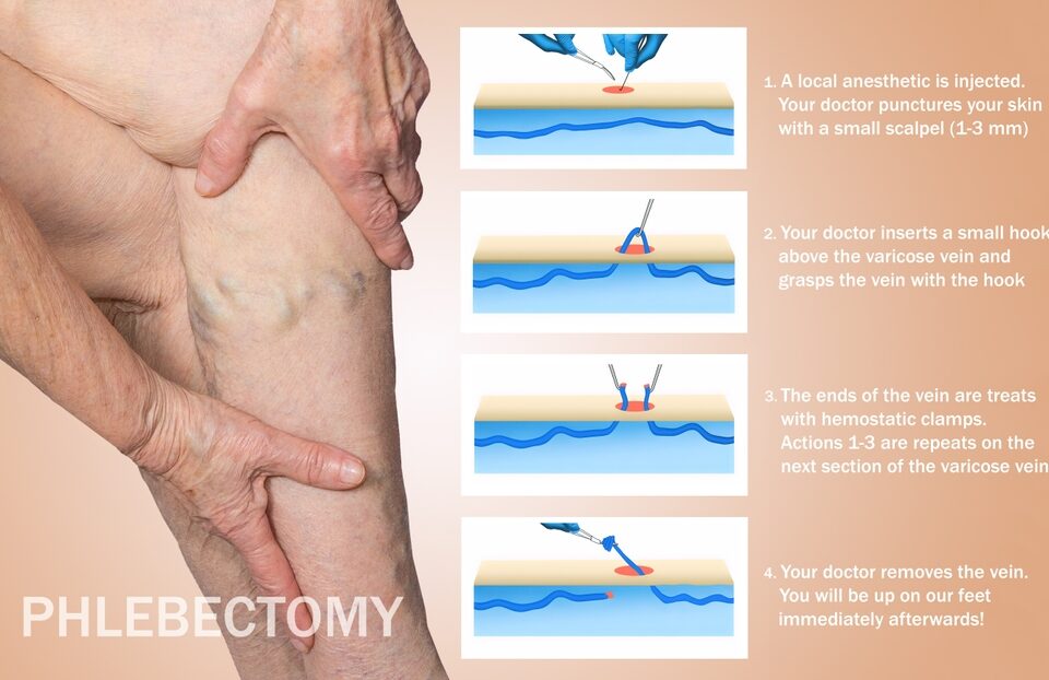 Ambulatory Phlebectomy Baltimore