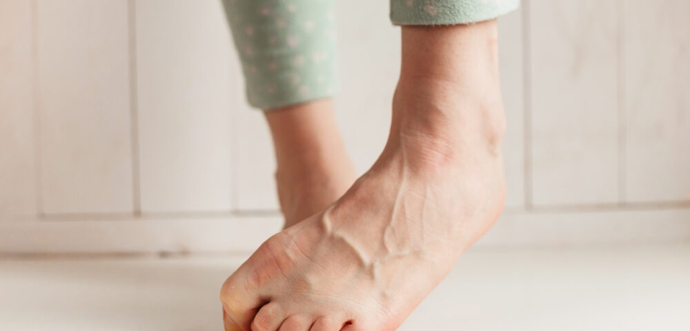 woman with bulging veins in feet