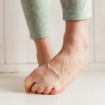 woman with bulging veins in feet