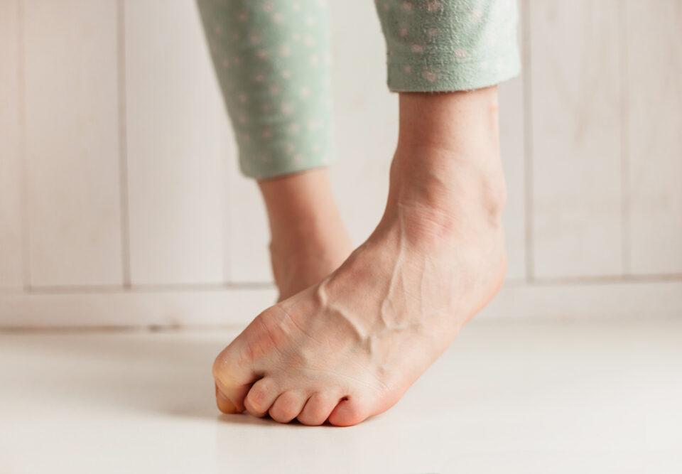 woman with bulging veins in feet