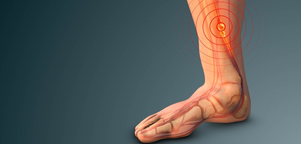 Deep Vein Thrombosis Harford County