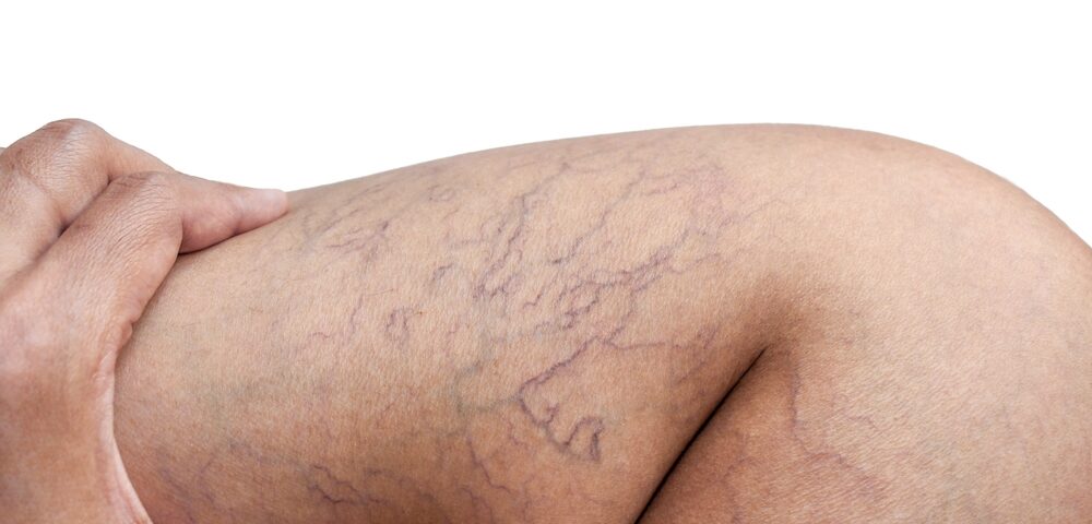 leg veins Central Maryland