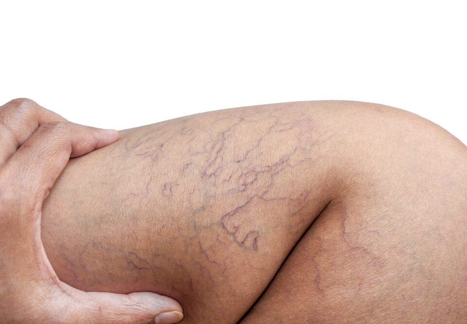 leg veins Central Maryland