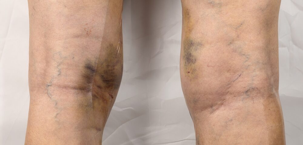 leg veins Harford County Maryland