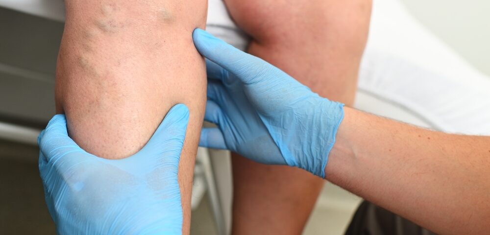 man in need of a Microphlebectomy in Maryland