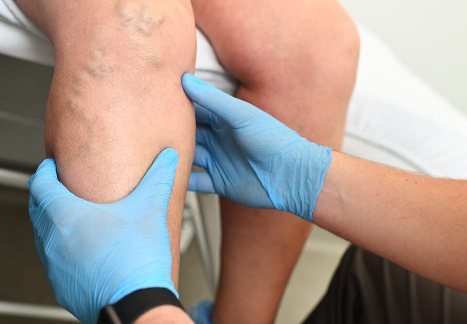 Microphlebectomy Maryland