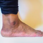 venous leg ulcers Central Maryland