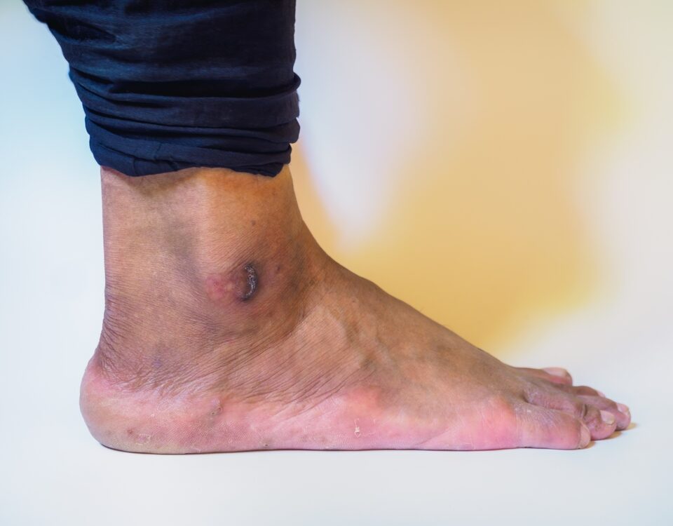 venous leg ulcers Central Maryland