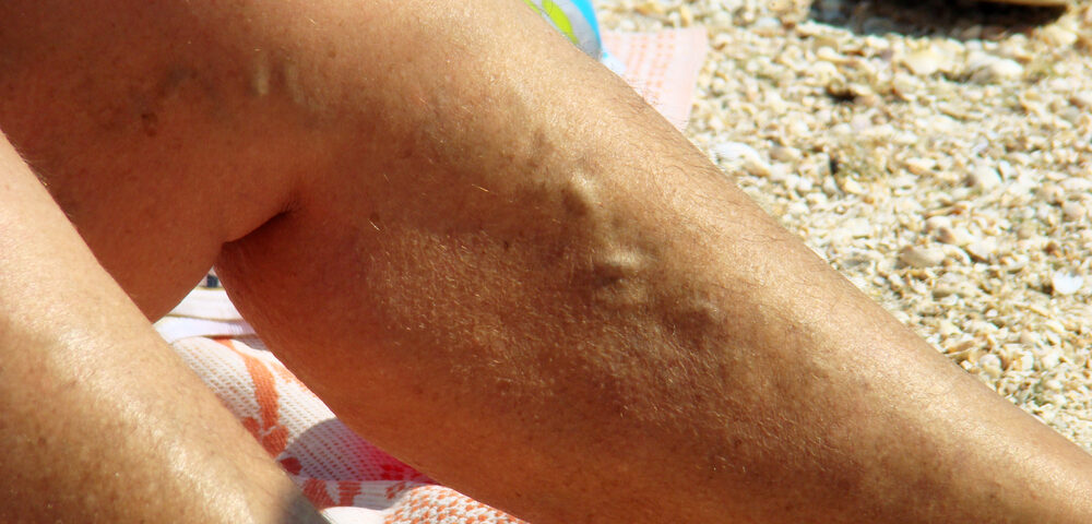 man dealing with poor circulation and varicose veins