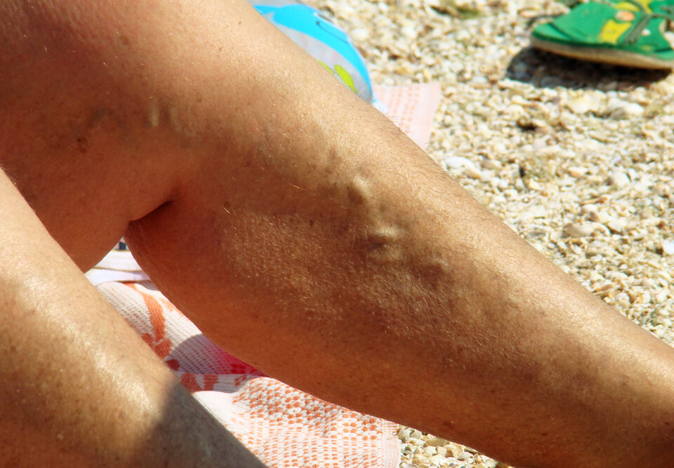 man dealing with poor circulation and varicose veins