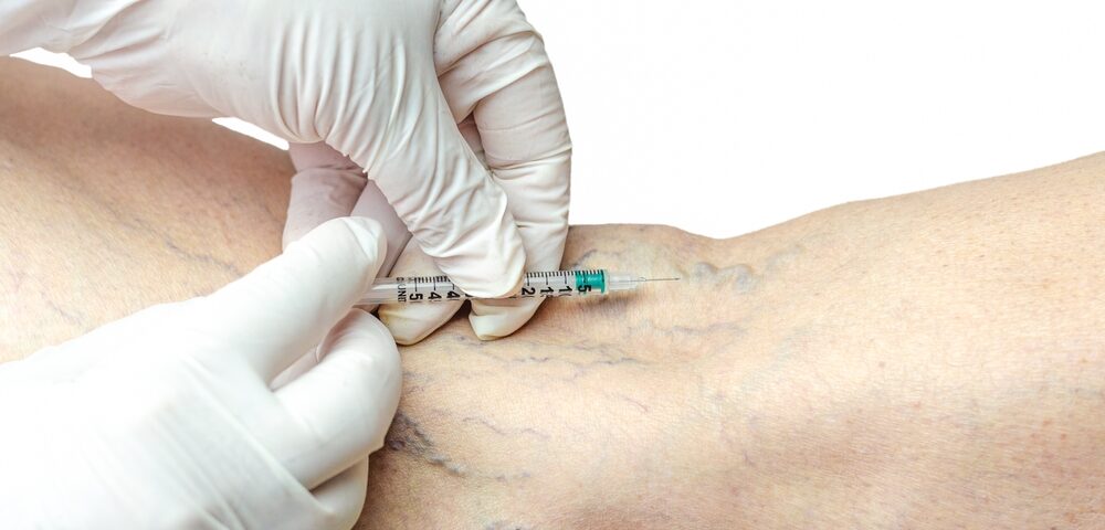 best sclerotherapy near me in Harford County