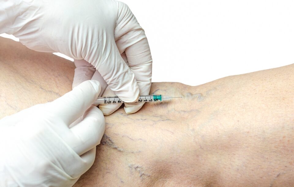 best sclerotherapy near me in Harford County