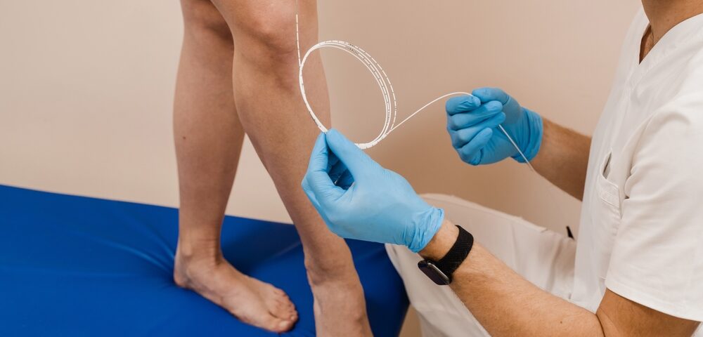 EVLA vein treatment near Columbia
