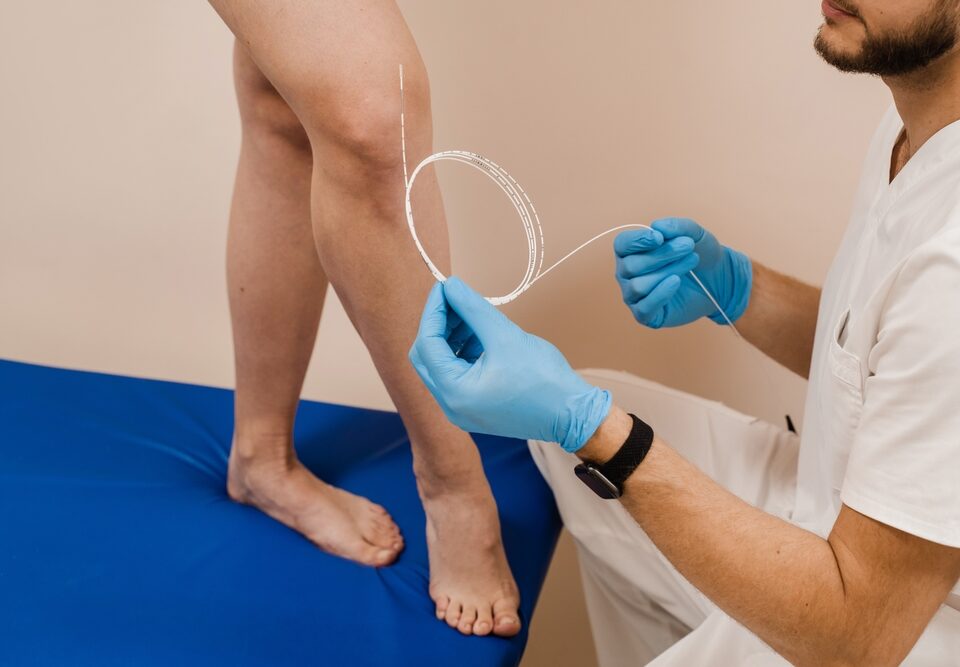 EVLA vein treatment near Columbia