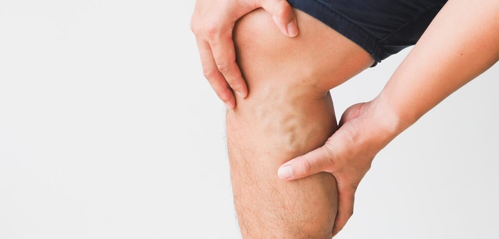 man after vein treatment with blood clots
