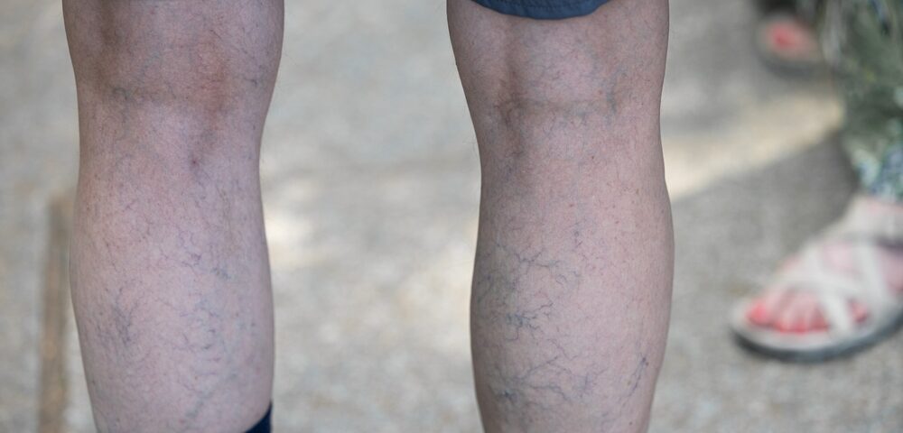 man in Havre de Grace with common vein conditions
