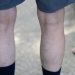 man in Havre de Grace with common vein conditions