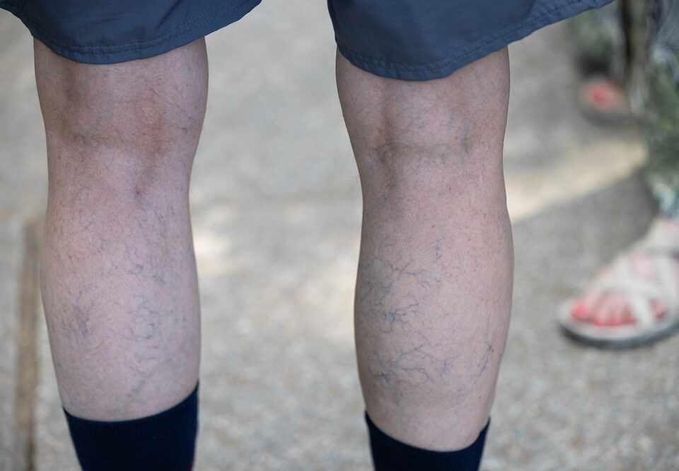 man in Havre de Grace with common vein conditions