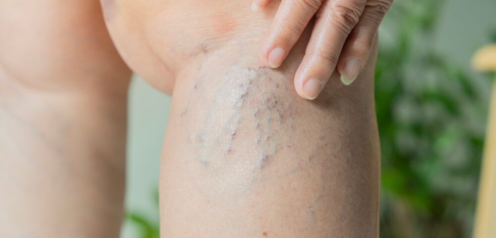 woman with vein issues in Havre de Grace