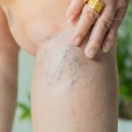 woman with vein issues in Havre de Grace