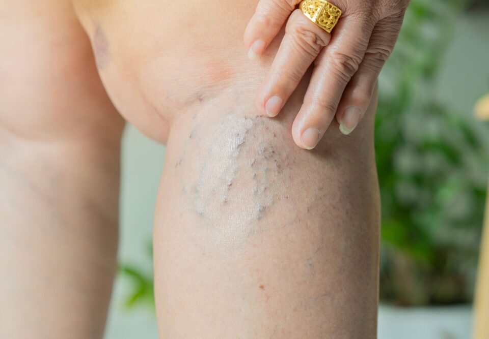 woman with vein issues in Havre de Grace