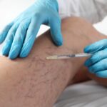 vein treatment in 21014 and 21015 Maryland