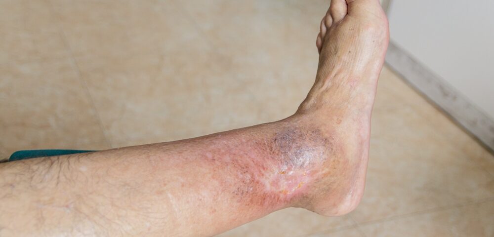 venous leg ulcers near York PA