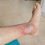 venous leg ulcers near York PA