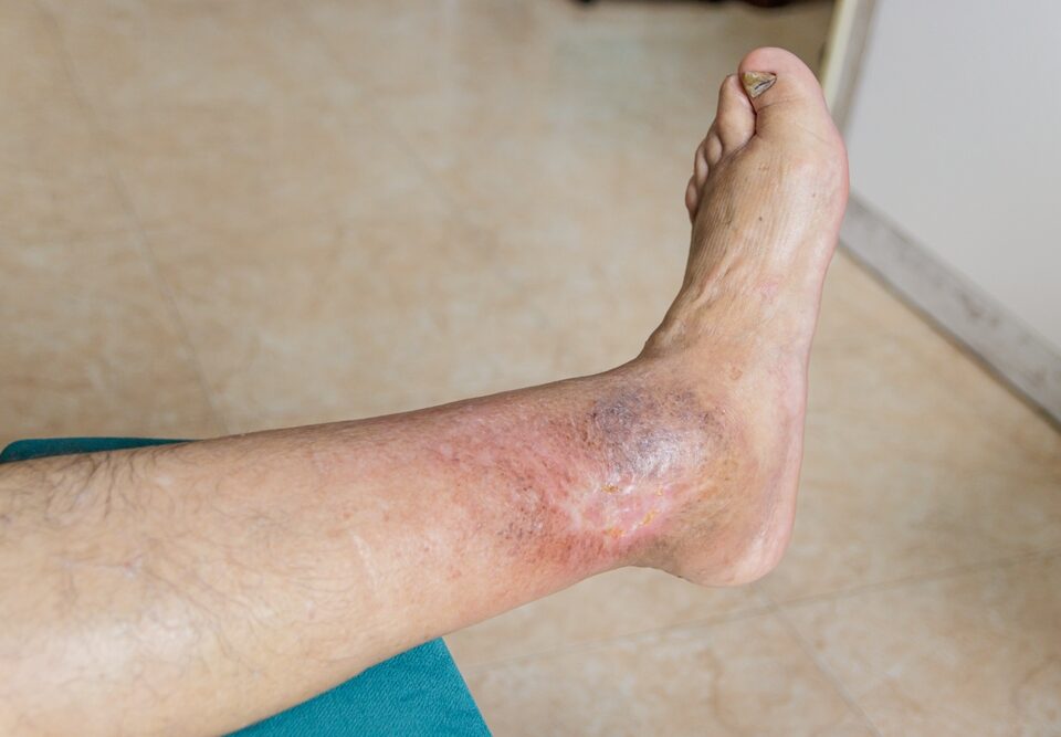 venous leg ulcers near York PA