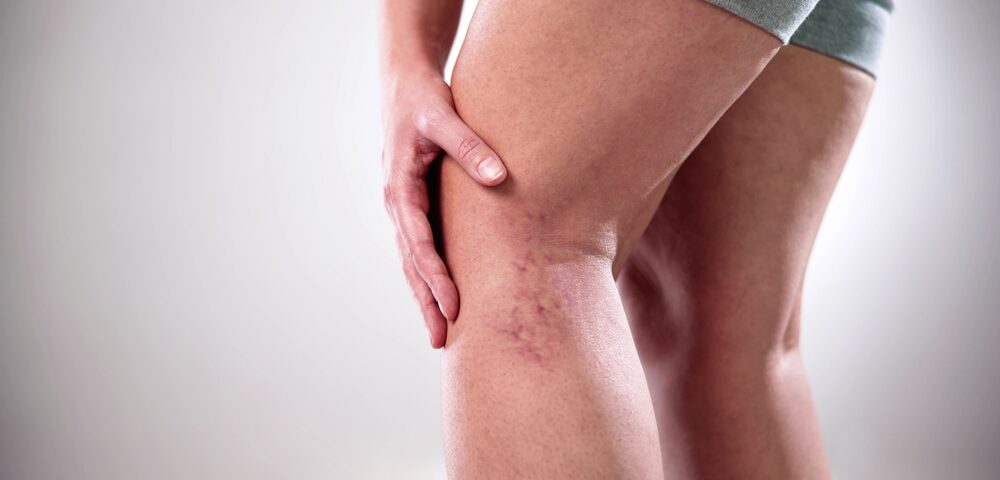 woman trying exercise to reduce the appearance of leg veins