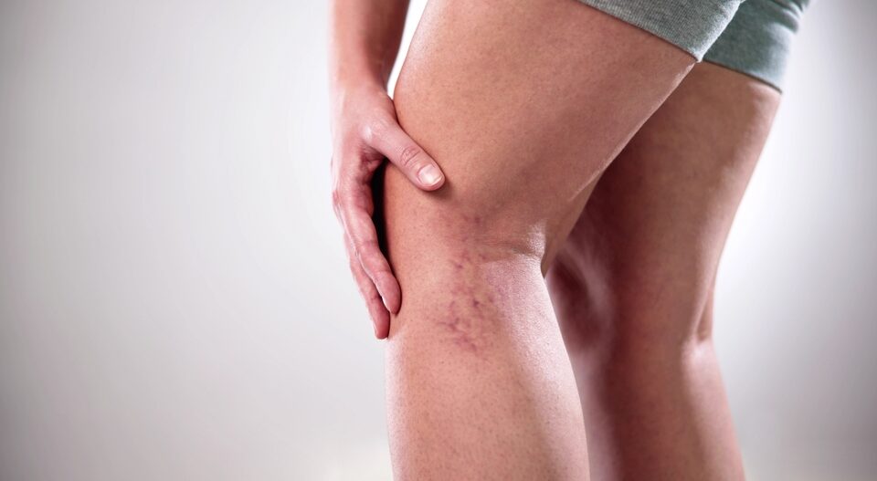 woman trying exercise to reduce the appearance of leg veins