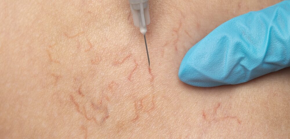 get rid of visible leg veins without surgery in Maryland