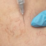 get rid of visible leg veins without surgery in Maryland