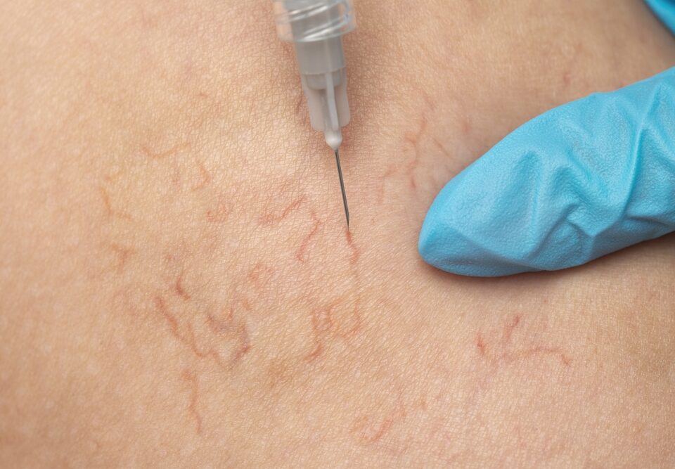 get rid of visible leg veins without surgery in Maryland
