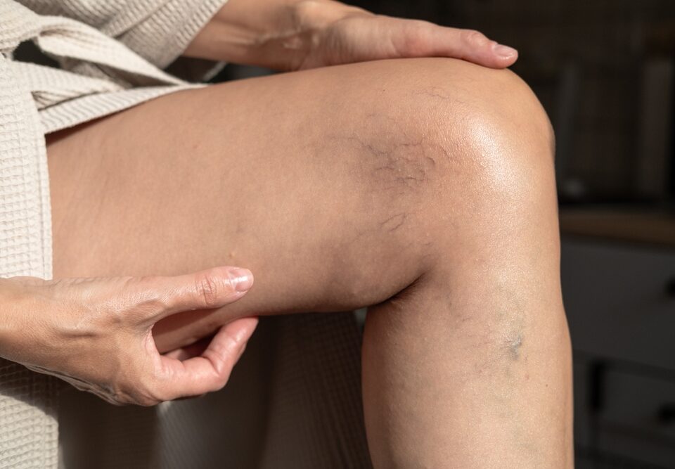 are spider veins a sign of poor circulation