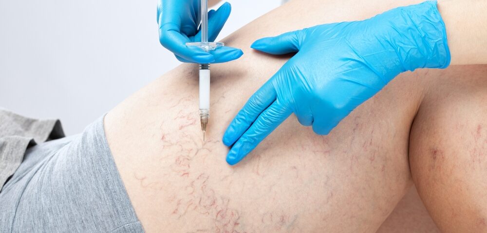 treat leg veins without a long recovery