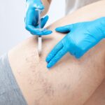 treat leg veins without a long recovery