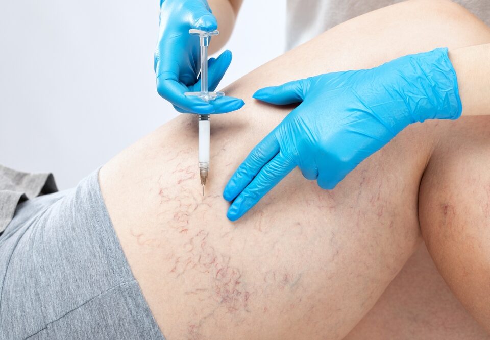 treat leg veins without a long recovery