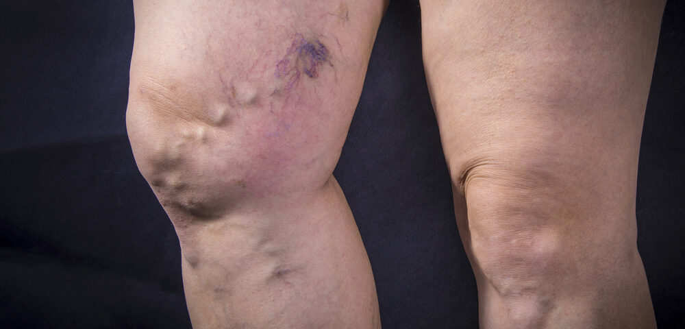 woman with dangerous varicose veins in legs