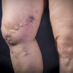 woman with dangerous varicose veins in legs