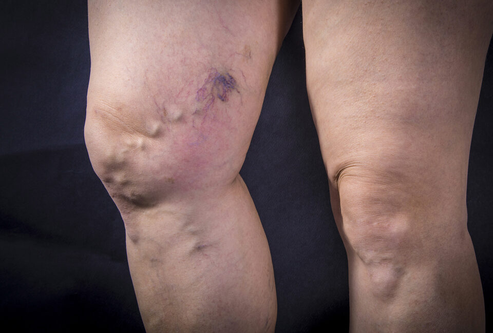 woman with dangerous varicose veins in legs