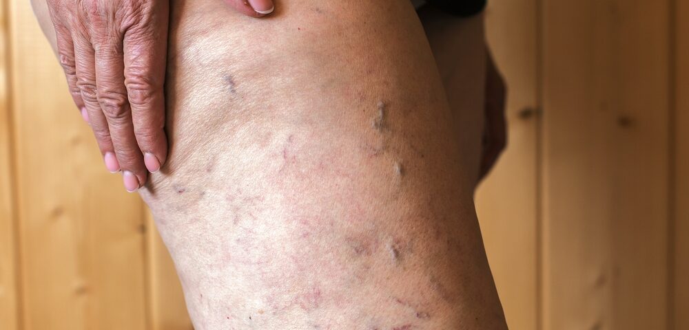 leg veins getting worse