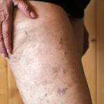 leg veins getting worse