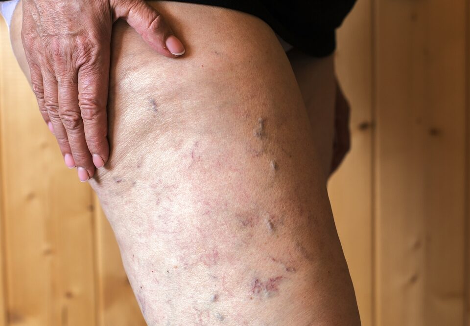 leg veins getting worse